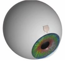 photo implant oculaire pour traiter un glaucome
